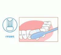 牙齿矫正期间注意事项